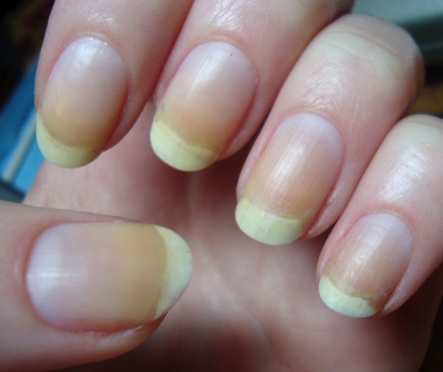 yellow nail syndrome #9