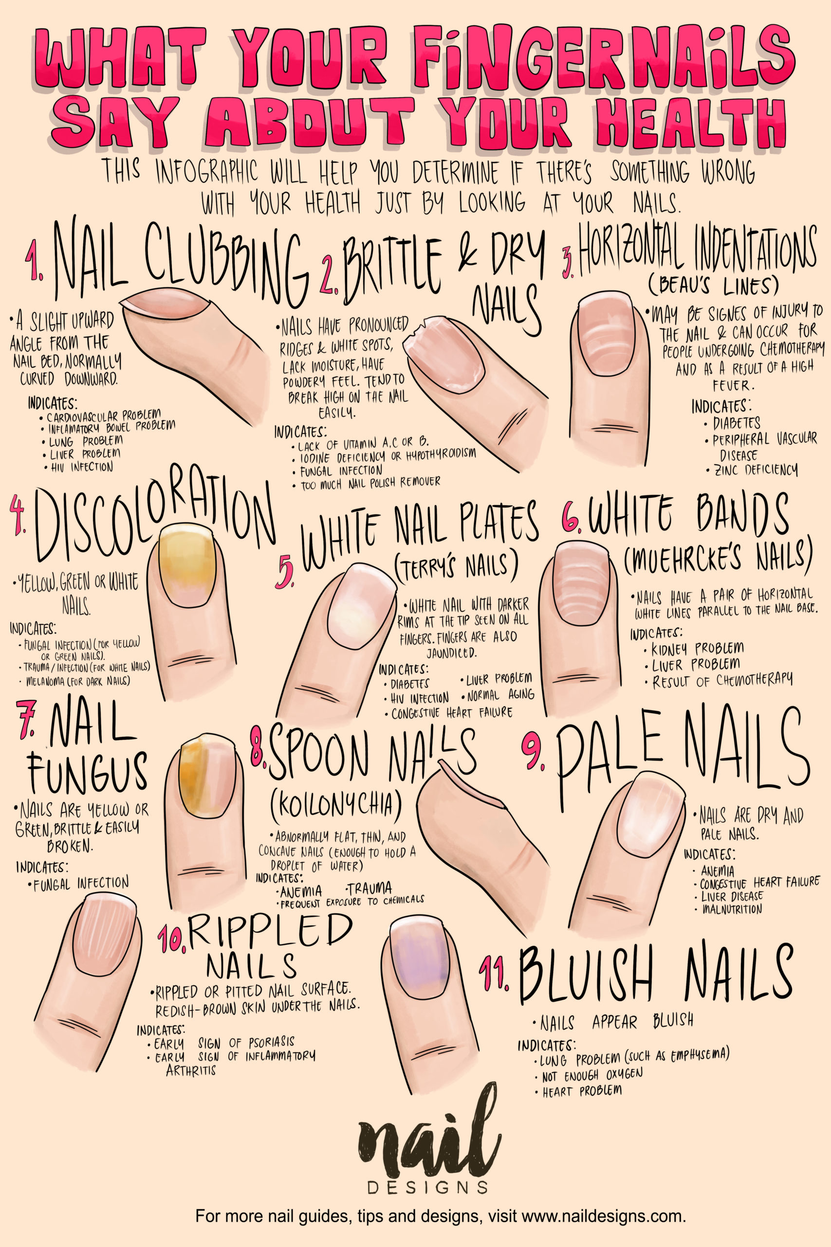 Infographic | What your Fingernails say about your health | Fingernail Health | Splitting Nails VS. Healthy Nails