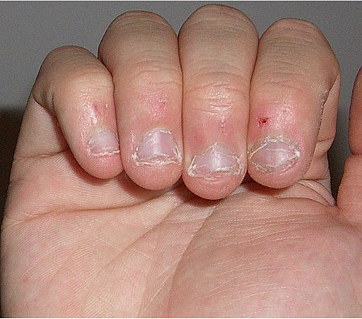 Healthy nails